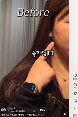 피부과 릴스 체험단 시술 전후 인스타그램 릴스 포트폴리오